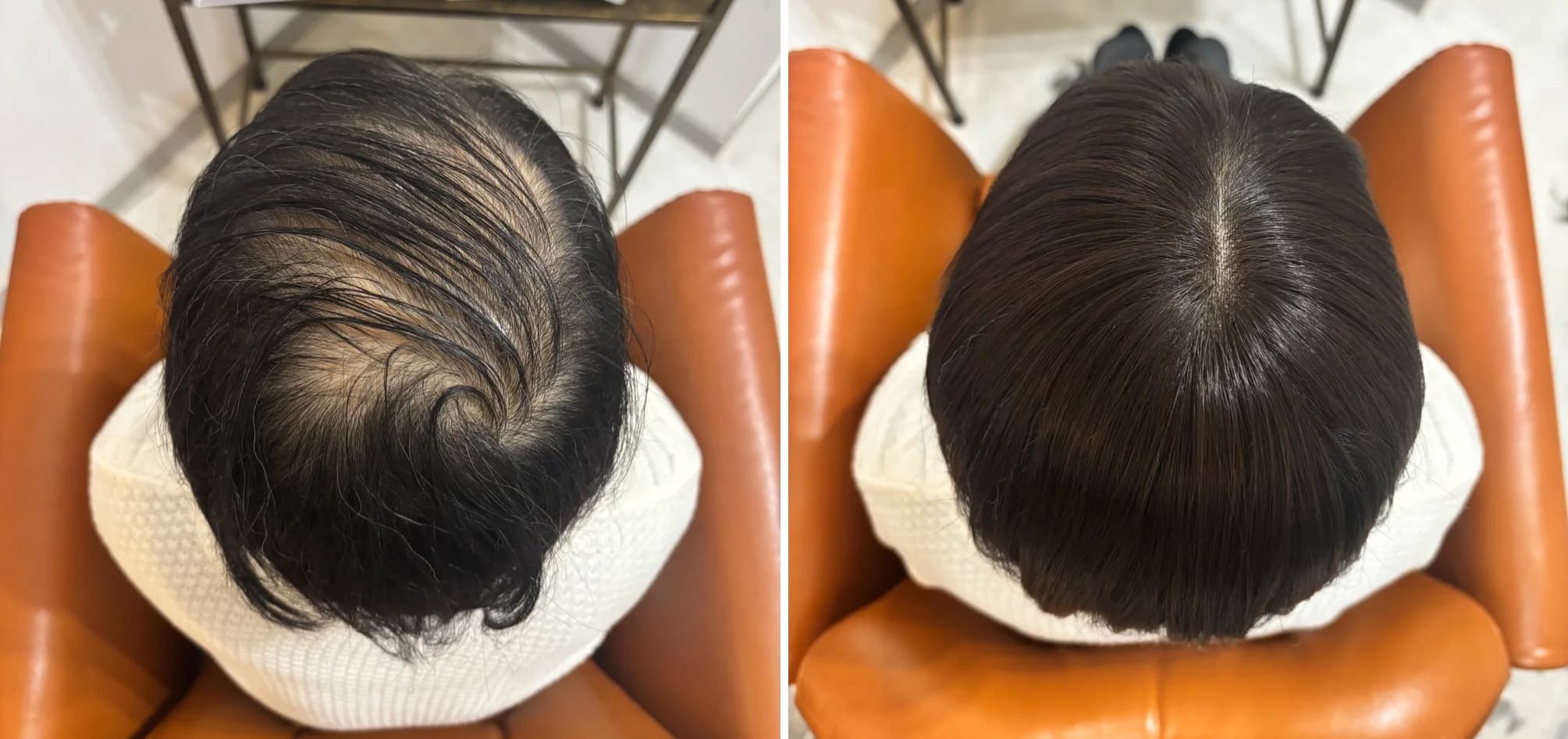 ヘアウィッグ制作の頭頂部ビフォーアフター